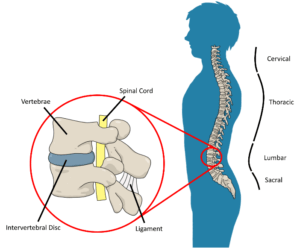 Tall People Back Pain and Back Problems: Disc Herniations