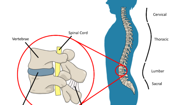 Tall People Back Pain and Back Problems: Disc Herniations