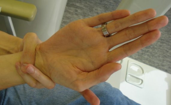 Tall Stature Disorders Marfan's Syndrome